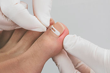 onyfix nail correction system onyfix nail correction system in the Miami, FL 33125 area